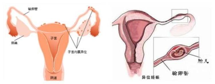 马来西亚试管婴儿