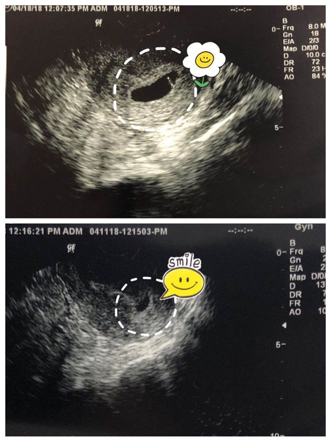 雌激素六项检查